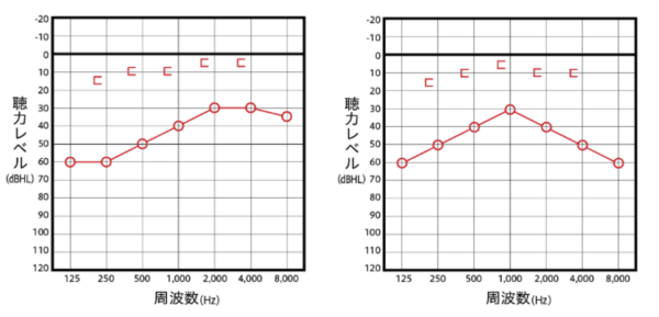 伝音性難聴の主なオージオグラム例