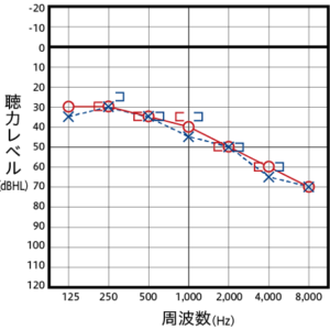 感音性難聴の主なオージオグラム例