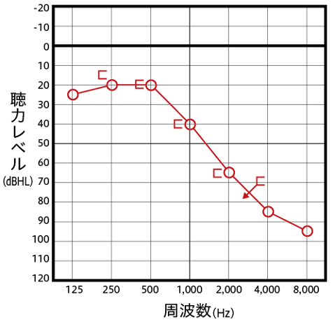 感音性難聴の主なオージオグラム例