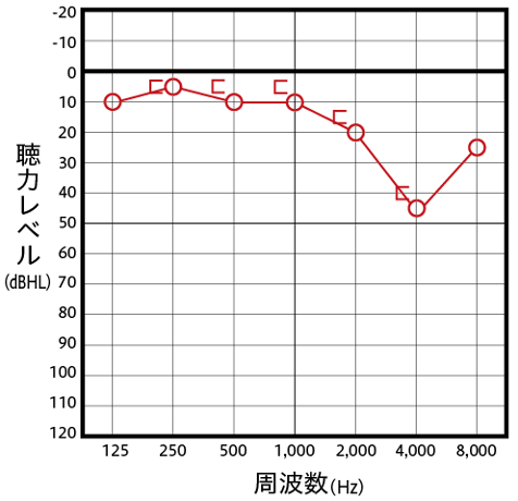 感音性難聴の主なオージオグラム例